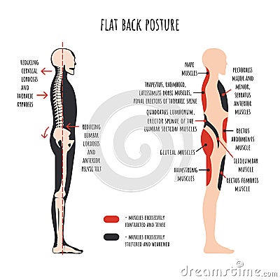 Flat back posture. The side view shows characteristic decrease natural curves of spine, pelvis rotation, stretched and weakened, Vector Illustration