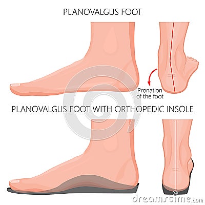Flat foot with orthopedic insole_Exretnal wiew Vector Illustration