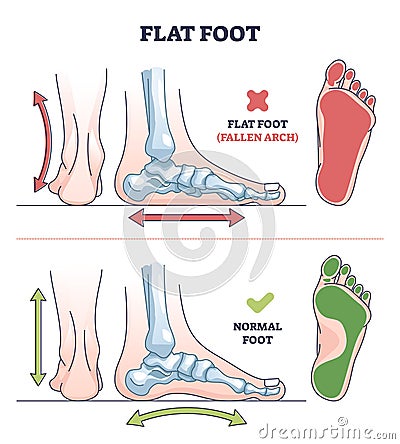 Flat foot pathology with fallen and normal arch comparison outline diagram Vector Illustration