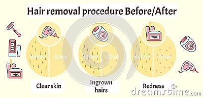 Flat vector hair removal aftereffects infographics Vector Illustration