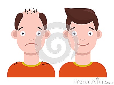 Flat vector illustration: man with bald head and man with thick hair. Hair transplant concept. Hair loss concept Cartoon Illustration