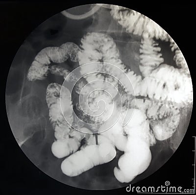 Fluoroscopic X-ray of the small intestine Stock Photo