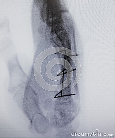 Fluoroscopic xray image fracture finger index exam Stock Photo