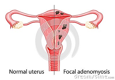 Focal Adenomyosis Human anatomy Female reproductive Sick system vs versus normal Compared educational healthy Vector Illustration