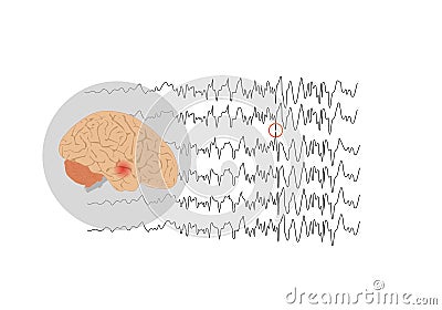 Focal seizure originating from temporal lobe Vector Illustration