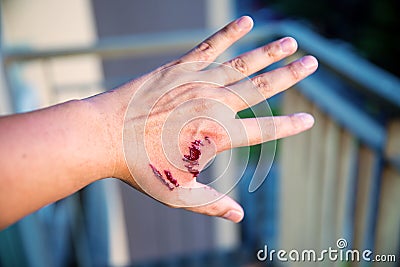 Focus dog bite wound and blood on hand. Infection and Rabies concept. Stock Photo