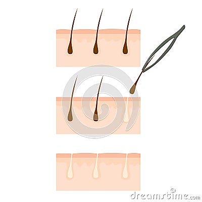 Follicle Hair Removal Stock Vector - Image: 70774820