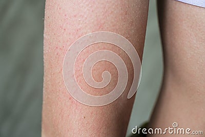 follicular hyperkeratosis is located on the person& x27;s arm Stock Photo
