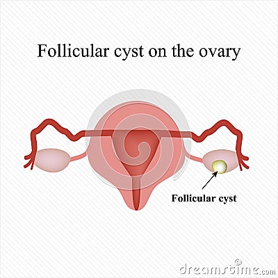 Follicular ovarian cyst. Functional . Infographics. Vector illustration Vector Illustration