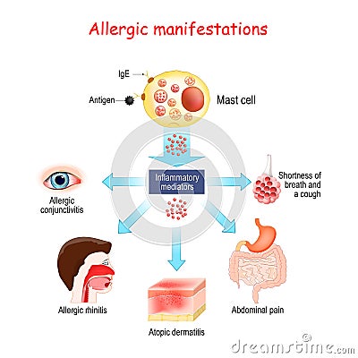 Food allergy and Allergic manifestations. Mast cell Vector Illustration