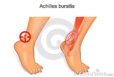 The foot is affected by Achilles bursitis Vector Illustration