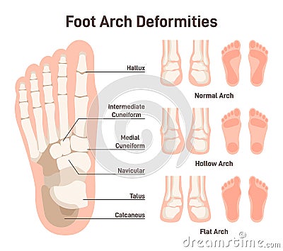 Foot anatomy scheme. Hollow and flat arch deformities. Diagram of normal Vector Illustration
