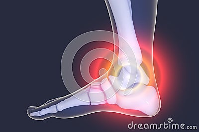 Foot and ankle pain, 3D illustration Cartoon Illustration