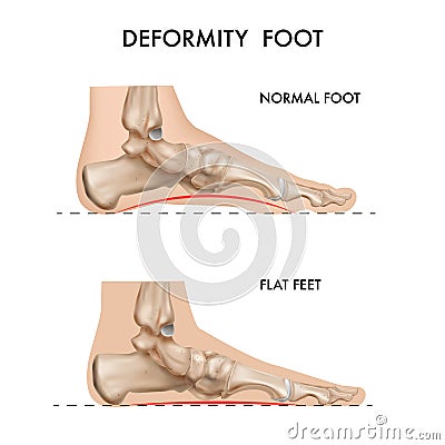 Foot Bones Deformation Composition Vector Illustration