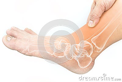 Foot bones injury Stock Photo