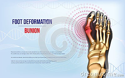 Foot deformation Bunion Vector Illustration