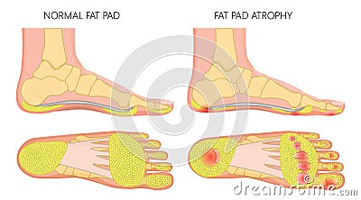 Foot fat pad atrophy Vector Illustration