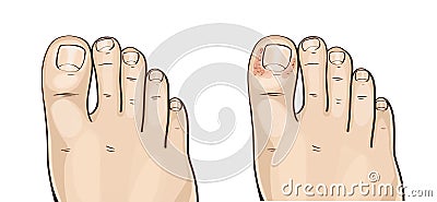 Foot herpes infections, medical illustration Cartoon Illustration