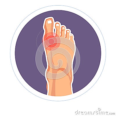 Foot joint injury toe pain arthritis or skeletone damage Vector Illustration