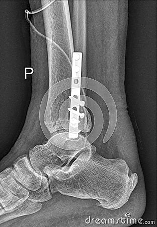 Foot Medical Xray Stock Photo