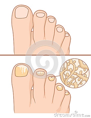 Foot with nail fungus and healthy foot Vector Illustration