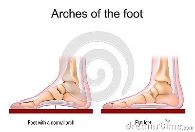 Foot with a normal arch and Flat feet Vector Illustration