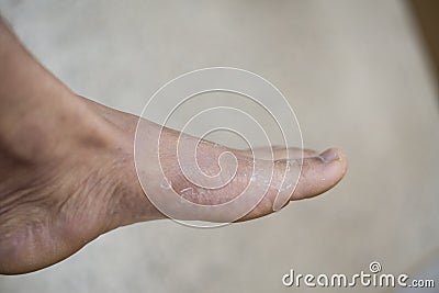 Foot of pateint skin dermatitis Stock Photo