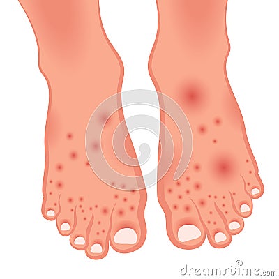 Foot with pathologies. Fungal lesions of the foot, nails and skin. Athlete`s foot, candidiasis, omnios. dermatitis. Dermatology ve Vector Illustration