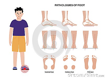 Foot pathologies poster Vector Illustration