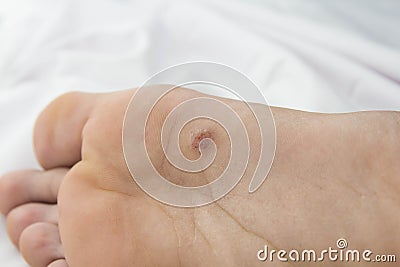 Foot with problem areas on the skin.close up Stock Photo