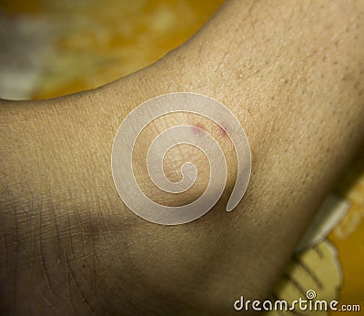 Foot With two Rashes Stock Photo