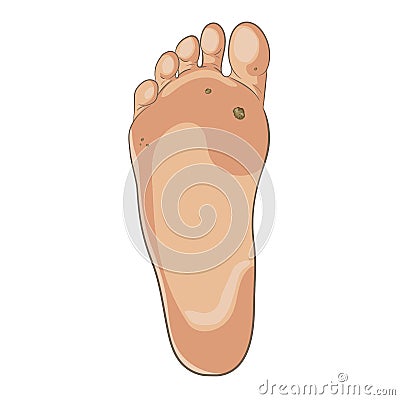 Foot wart. Foot bottom pathology: verruca, wart, papilloma virus. Vector Illustration