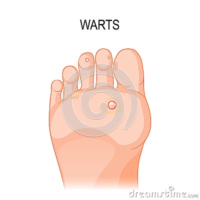 Foot wart Vector Illustration