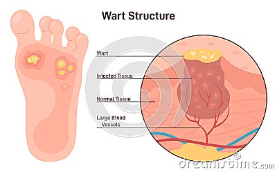 Foot warts. Type of human papillomavirus on the bottom of soles and toes Vector Illustration