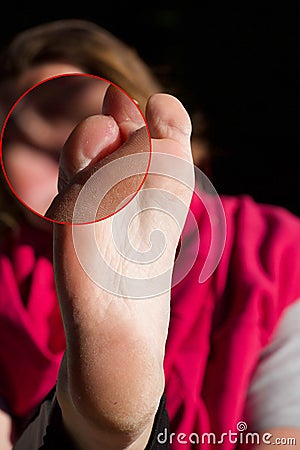 A Foot a woman finger with blisters Stock Photo