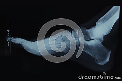 Foot x-ray Stock Photo