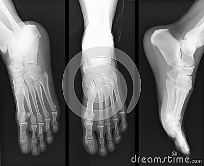 Foot x-ray Stock Photo