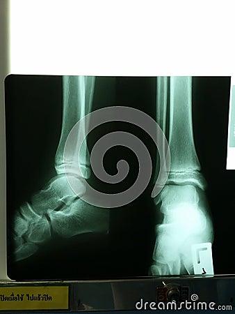 foot x-rays Stock Photo