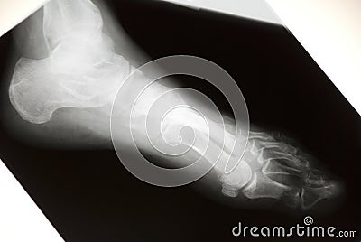 Foot Xray Stock Photo