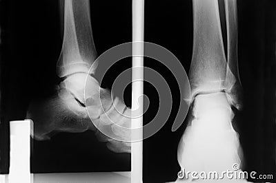 Foot xray Stock Photo