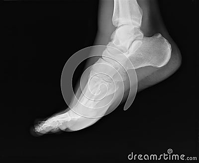 Foot xray Stock Photo