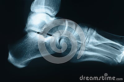 Foot xray Stock Photo