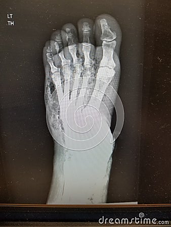 Foot xray showing soft tissue gas in patient with necrotizing fasciiitis Stock Photo
