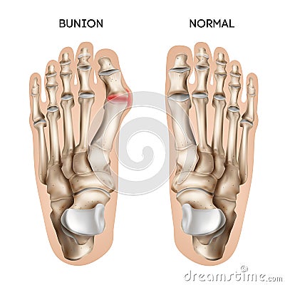 Footstep Bunion Realistic Composition Vector Illustration