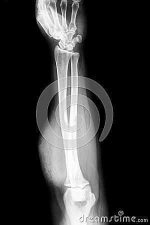 Forearm x-ray Stock Photo