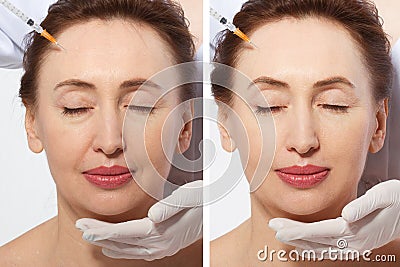 Forehead plastic surgery before and after. Middle age woman wrinkled face close up. Facial contouring, anti aging fillers concept Stock Photo