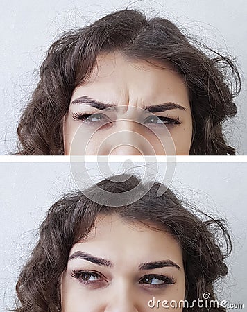 Forehead woman wrinkles before and after Stock Photo