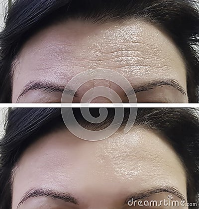 Forehead women wrinkles before and after Stock Photo