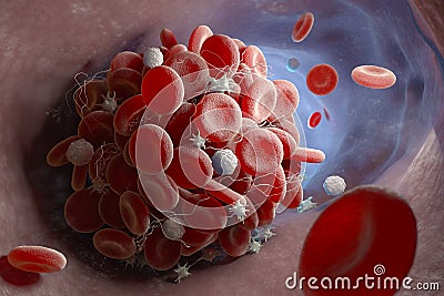 Formation of a blood clot Cartoon Illustration