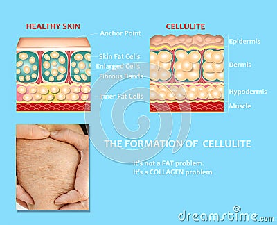 forming of underskin cellulite illustration Cartoon Illustration